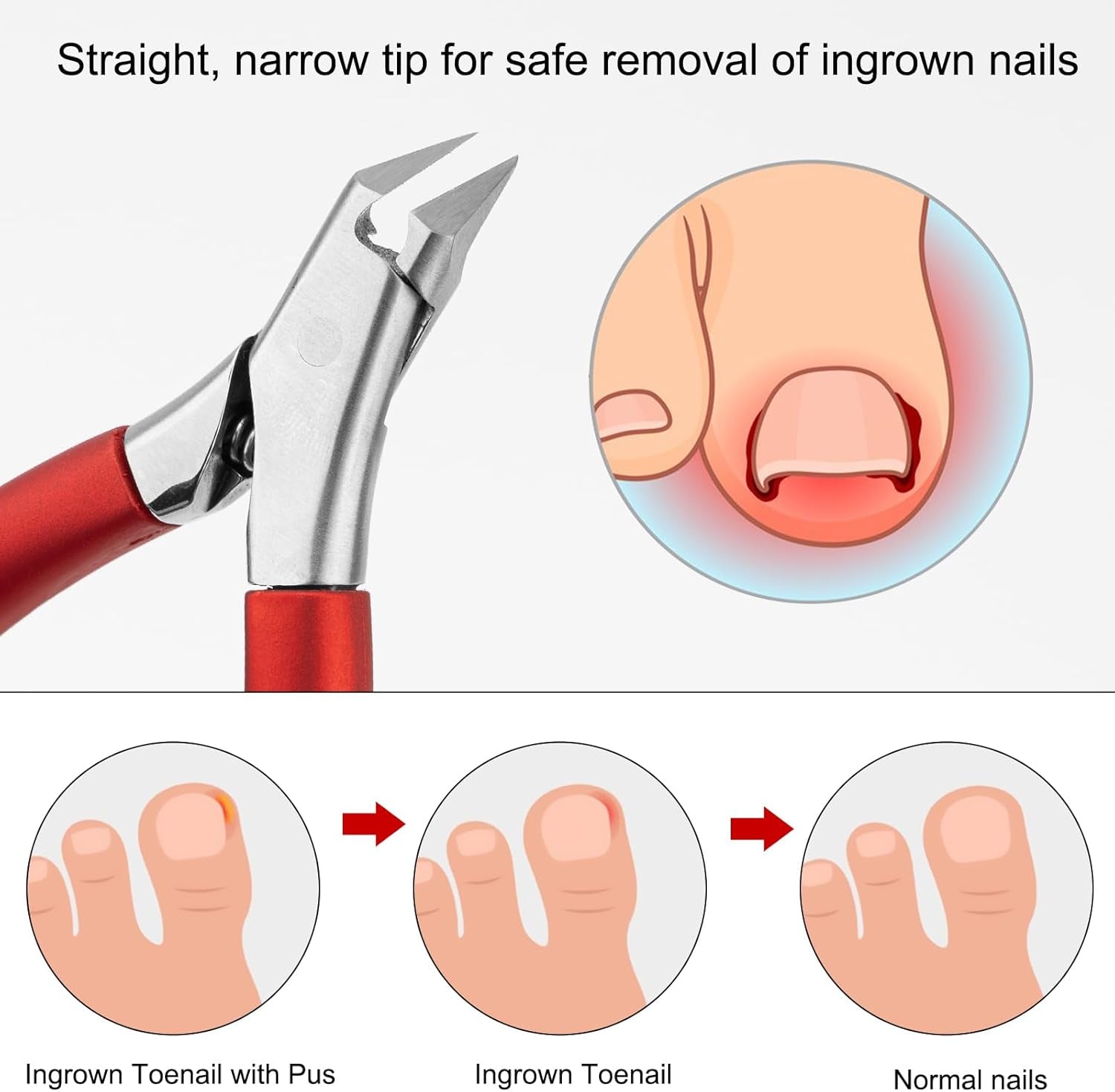 Toenail Clippers for Ingrown Toenail, Stainless Steel Professional Ergonomic Straight Blade Nail Clippers for Thick Nails Dead Skin Calluses (Red)